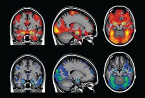 Autism and Brain Imaging: What fMRI and EEG Reveal